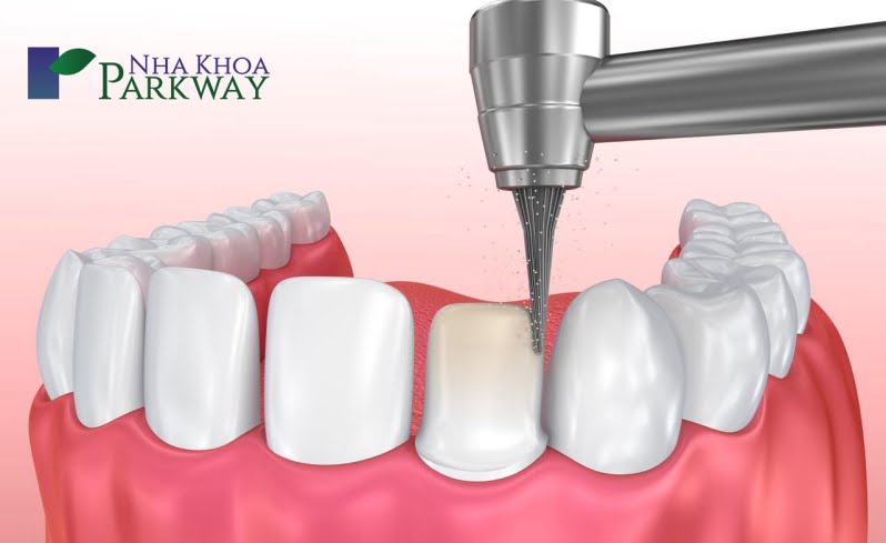Cách mài răng an toàn và hiệu quả tại nha khoa