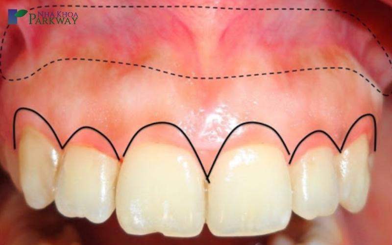 Chi tiết vị trí chính xác của các xương ổ răng