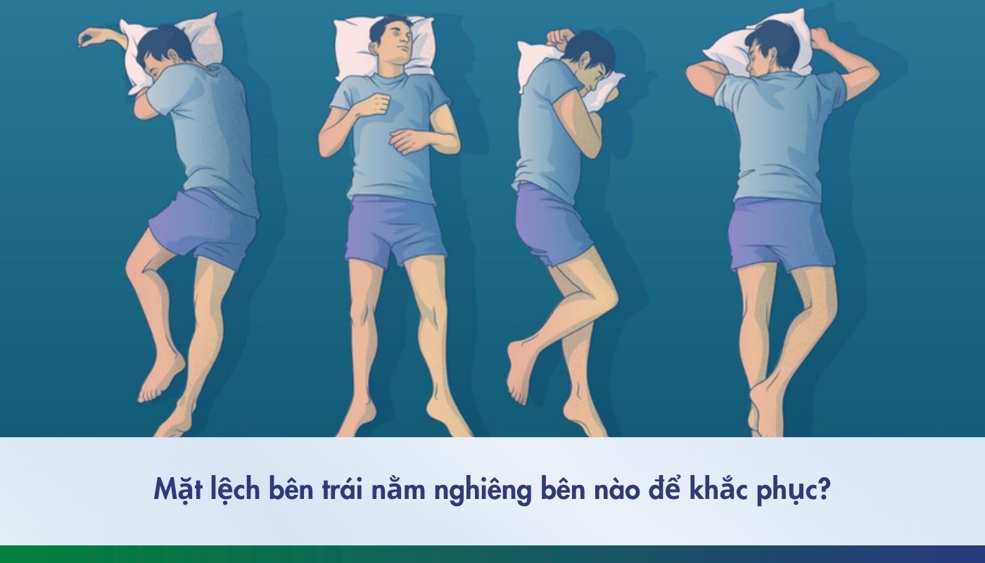 Mặt lệch bên trái nằm nghiêng bên nào để khắc phục