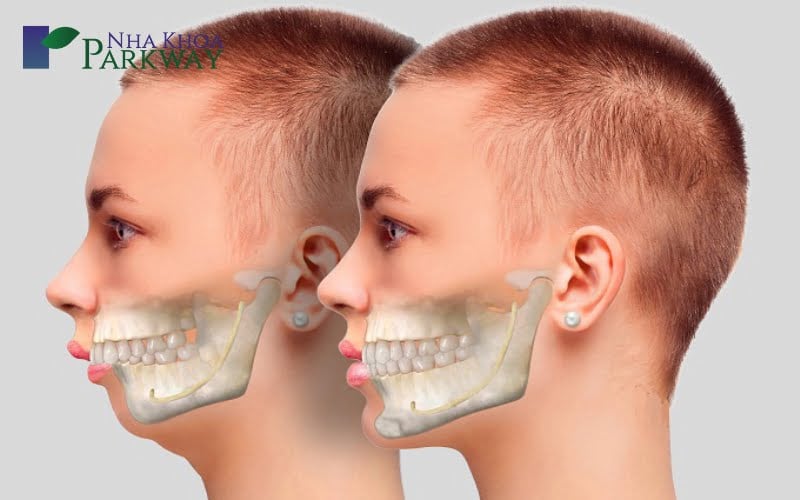 Hình ảnh so sánh giữa hàm răng bình thường và hàm răng hô