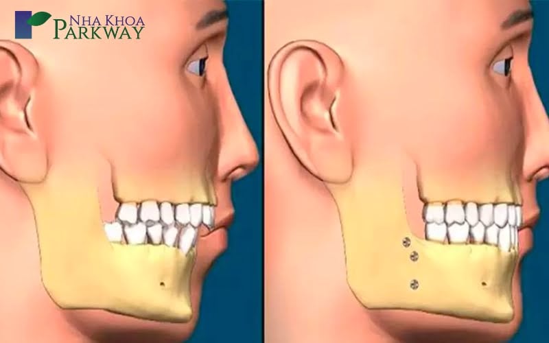 Minh họa sự khác biệt giữa răng bình thường và răng hô