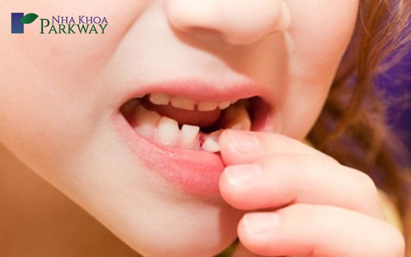 Răng cửa hàm dưới của một đứa trẻ bị gãy