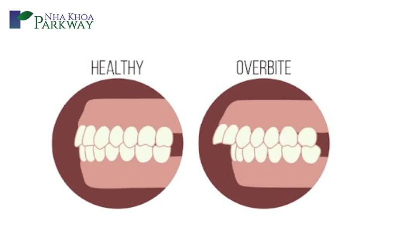 Hình ảnh so sánh răng bình thường và răng hô