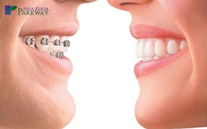 Niềng răng mắc cài khắc phục tình trạng răng hô mang lại cho bạn nụ cười tự tin