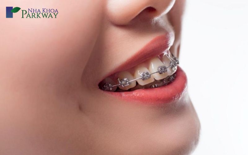 Niềng răng là phương pháp cải thiện tình trạng răng hô mang lại cho bạn nụ cười tự tin và xinh xắn