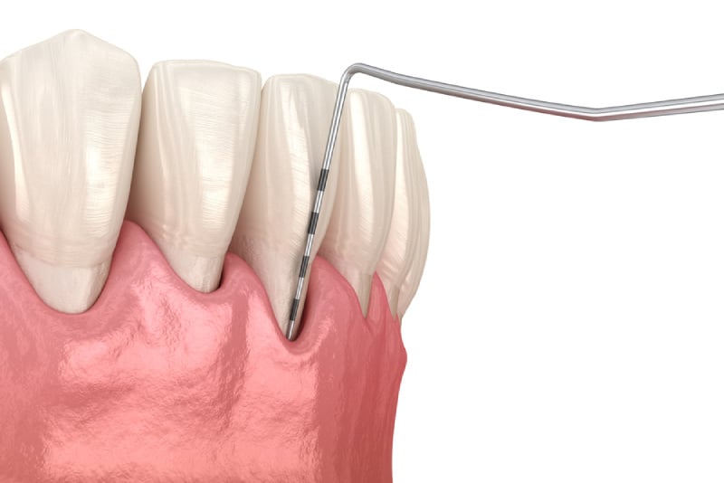 Hình ảnh mô phỏng hàm răng đã được vệ sinh sạch cao răng