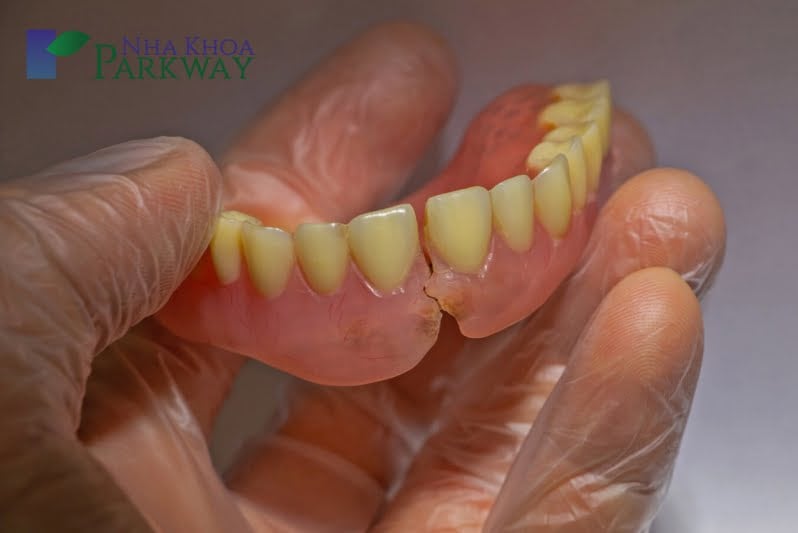Hàm răng giả đã qua sử dụng bị ố vàng và hư hỏng