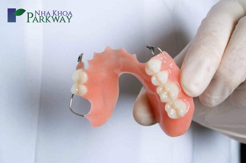 Hàm răng giả được nẹp cố định bằng kim loại