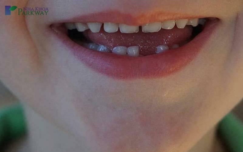 Răng cửa hàm dưới bị gãy