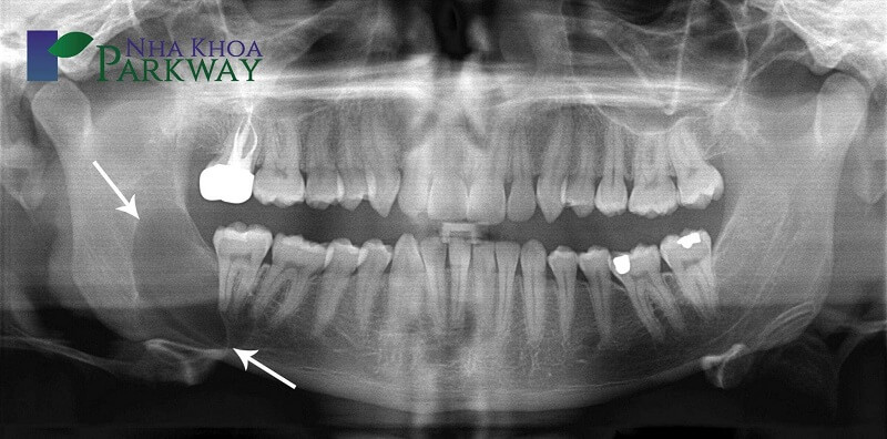 Một trong những biểu hiện của u nang chân răng chính là xương hàm bị sưng