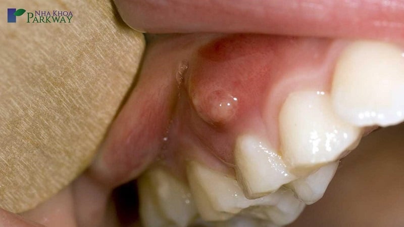 Viêm nang chân răng gây ra nhiều tác hại nặng nề
