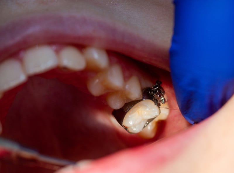 Hình ảnh chiếc răng đang được cố định bằng kim loại