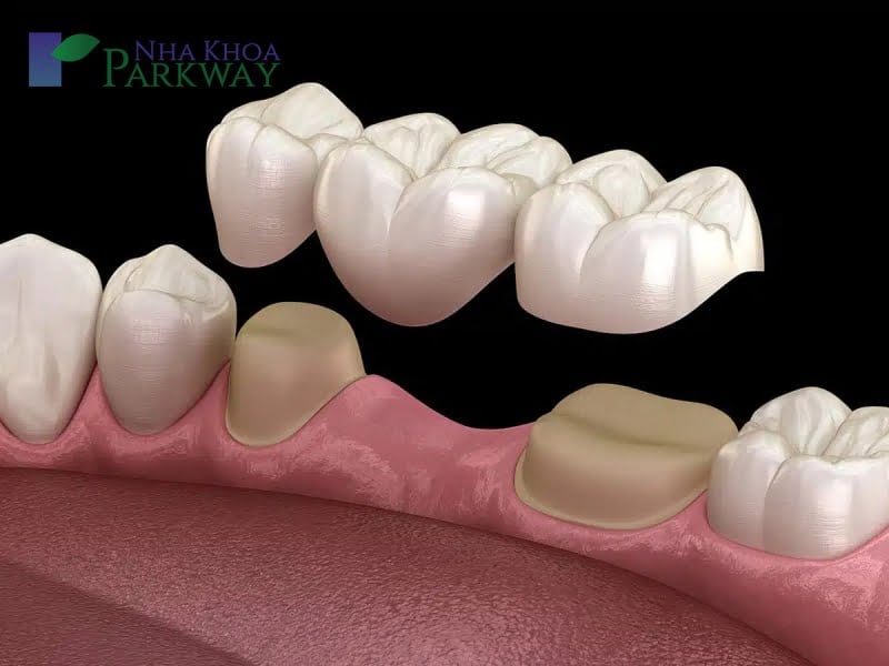 Răng giả cố định là gì?