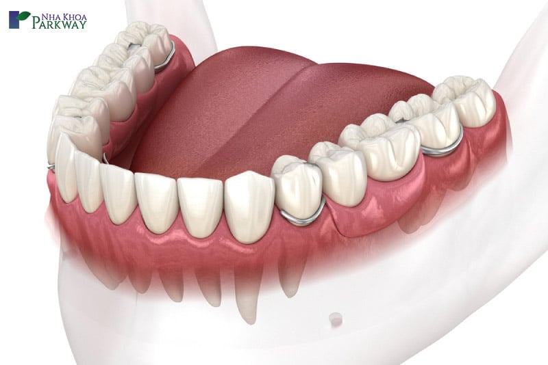 hình ảnh mô phỏng hàm răng đã hoàn thành quy trình trồng răng giả tháo lắp  
