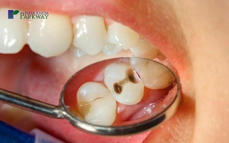 Có nên nhổ răng hàm trên trong cùng bị sâu hay không?