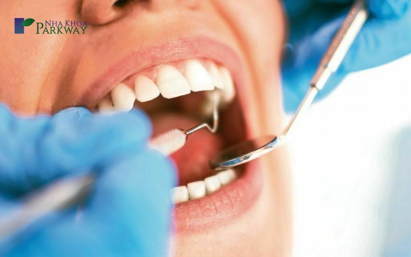 Phương pháp nhổ nhổ răng sâu hàm trên phổ biến nhất hiện nay