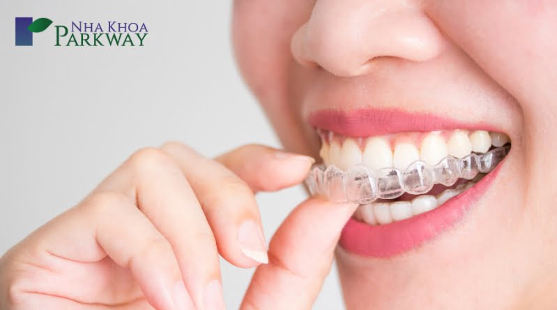 Lựa chọn phương pháp niềng răng hợp lý nhất với đối tượng bệnh nhân