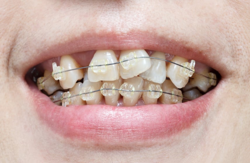 Hình ảnh khách hàng niềng răng mắc cài vì răng bị lệch
