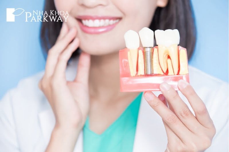 Mô hình so sánh giữa trồng răng Implant và răng tự nhiên
