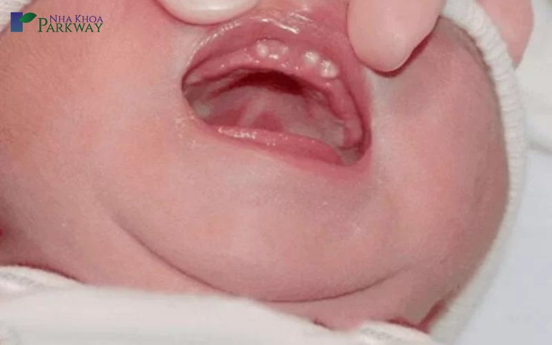 Răng nanh sữa hình ảnh lợi trẻ sắp mọc răng