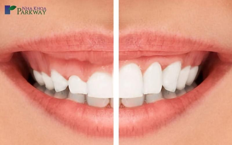 Hình ảnh so sánh trước và sau khi mài xương ổ răng