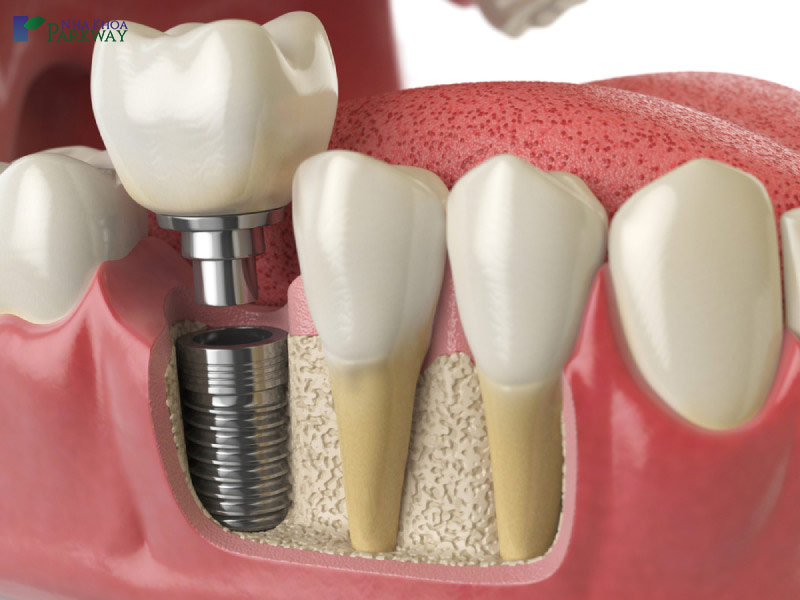 Gắn cầu răng sứ để hoàn tất quy trình trồng răng implant