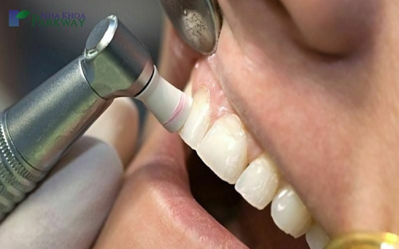 Sau khi hoàn tất lấy cao, bác sĩ đánh bóng bề mặt răng giúp răng trông sáng và đẹp hơn