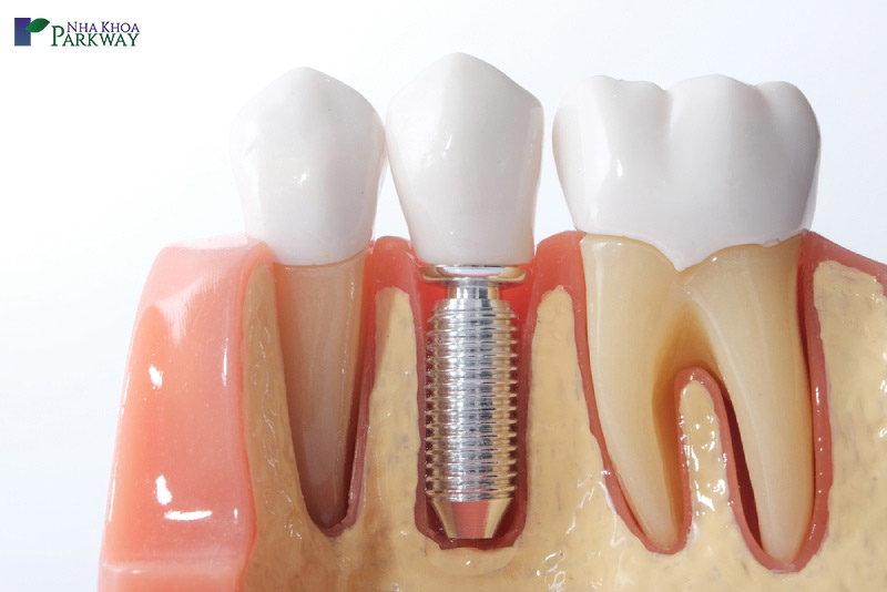 quy trình làm răng implant mất thời gian bao lâu