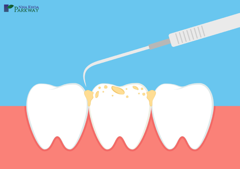 quy trình lấy cao răng chuẩn bộ y tế