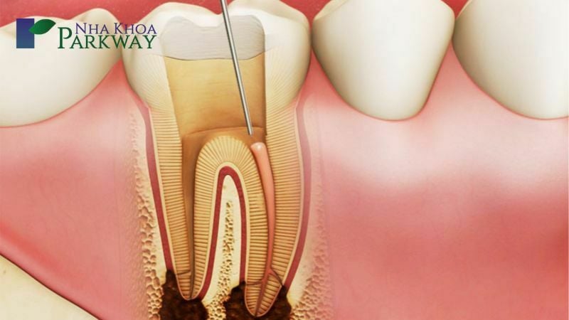 Mô phỏng quá trình rút tủy răng
