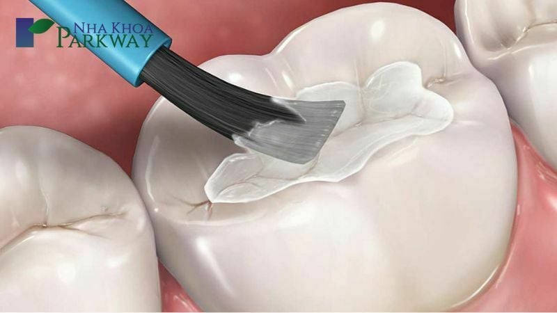 Mô phỏng quá trình trám bít lỗ sau khi lấy tủy răng