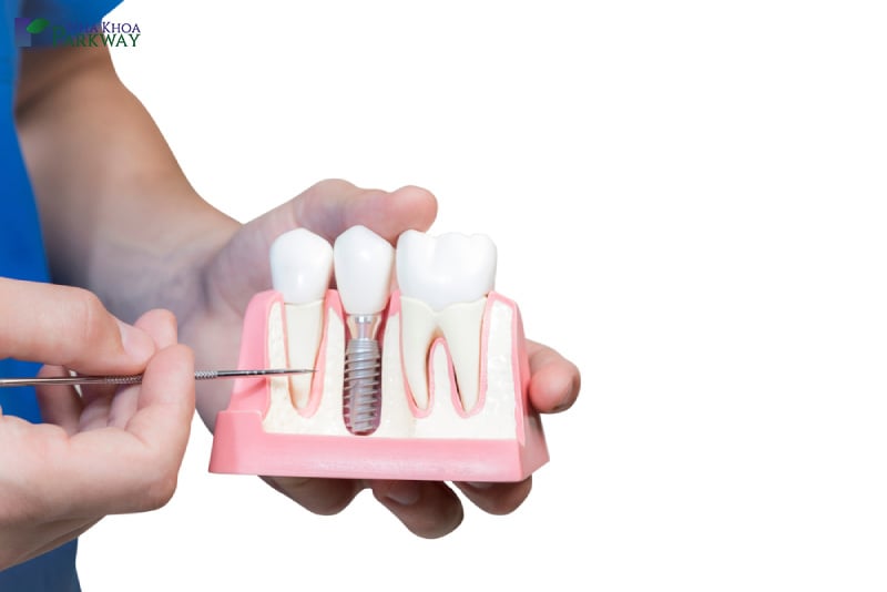 Mô tả quy trình trồng răng implant