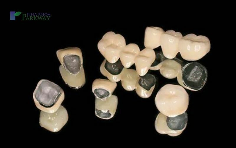 Những chiếc răng sứ kim loại là một trong những nguyên nhân gây nên tình trạng răng đen mặt trong