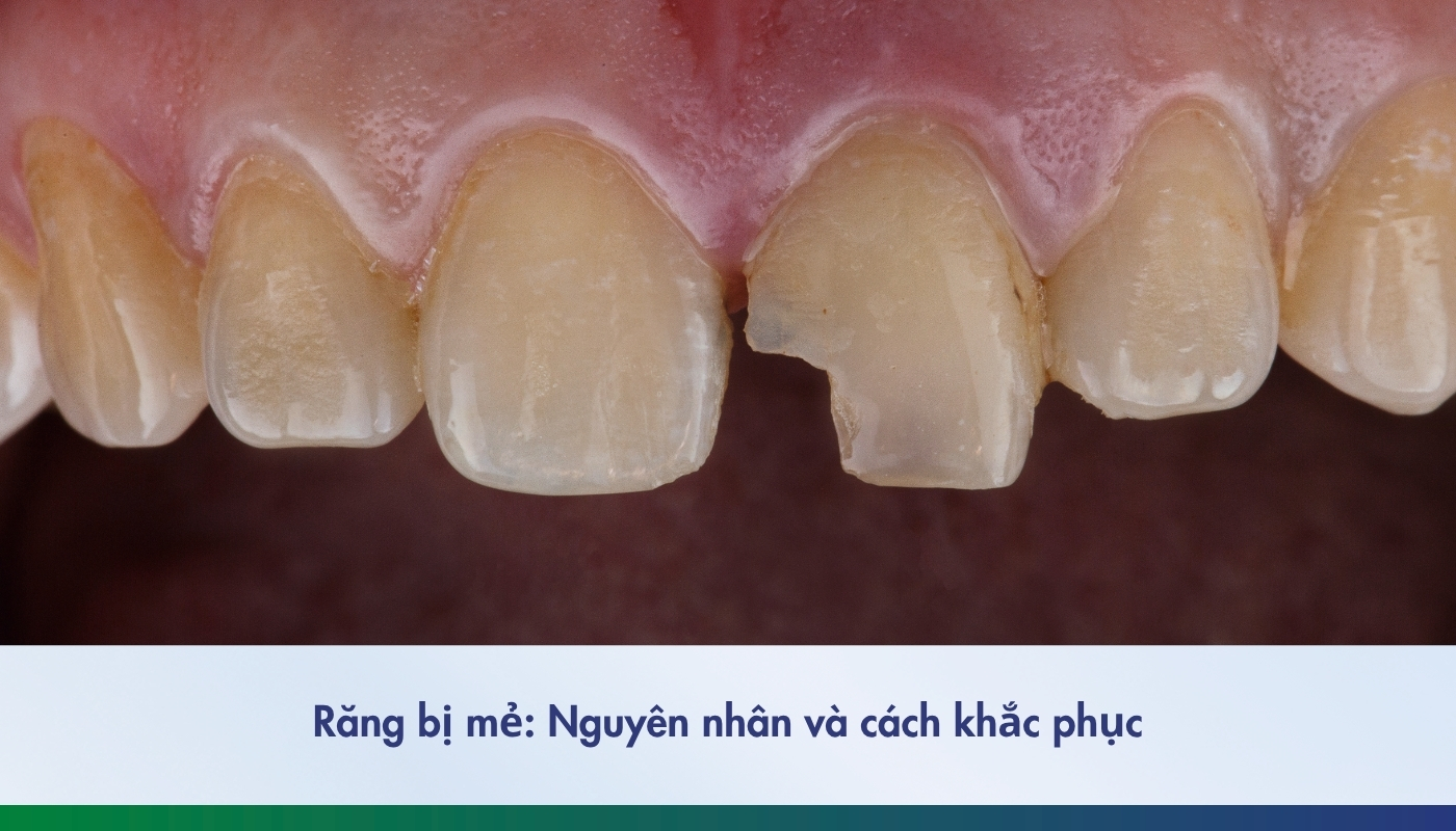 Răng bị mẻ nguyên nhân và cách khắc phục