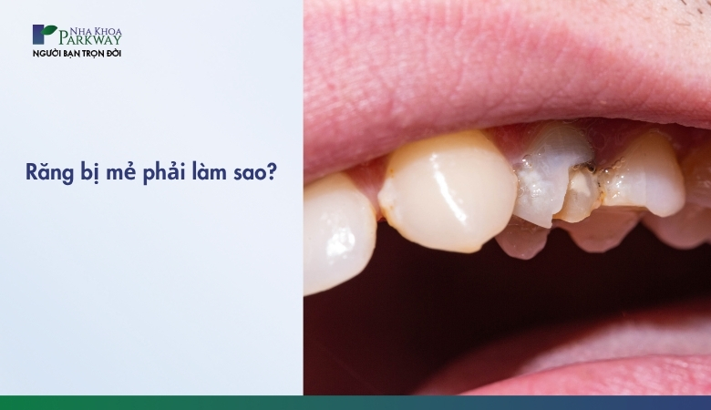 Răng bị mẻ phải làm sao