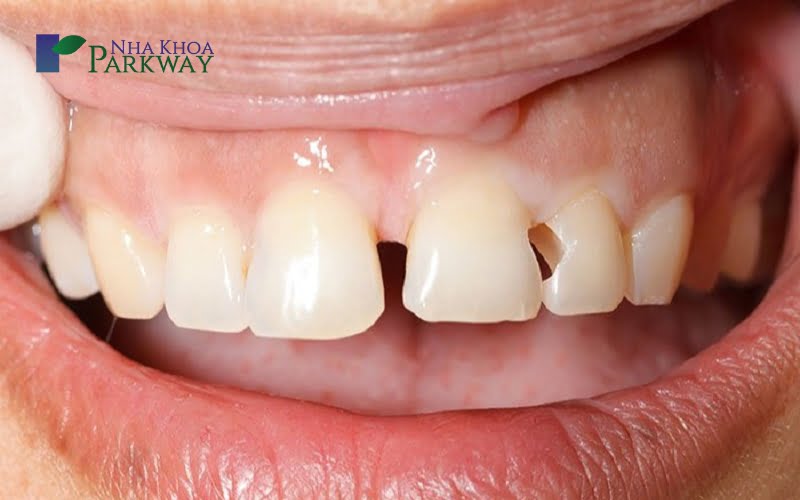 Những bệnh lý thường gặp ở răng cửa và cách khắc phục