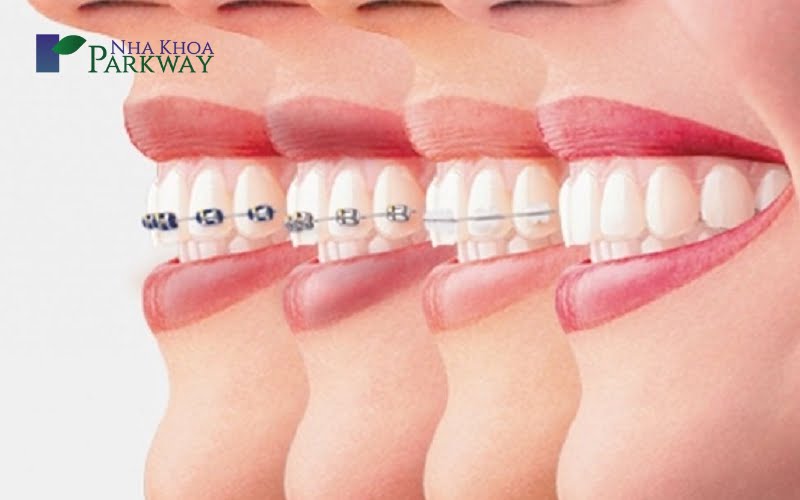 Niềng răng cho răng cửa lệch chữ V có thực sự hiệu quả?