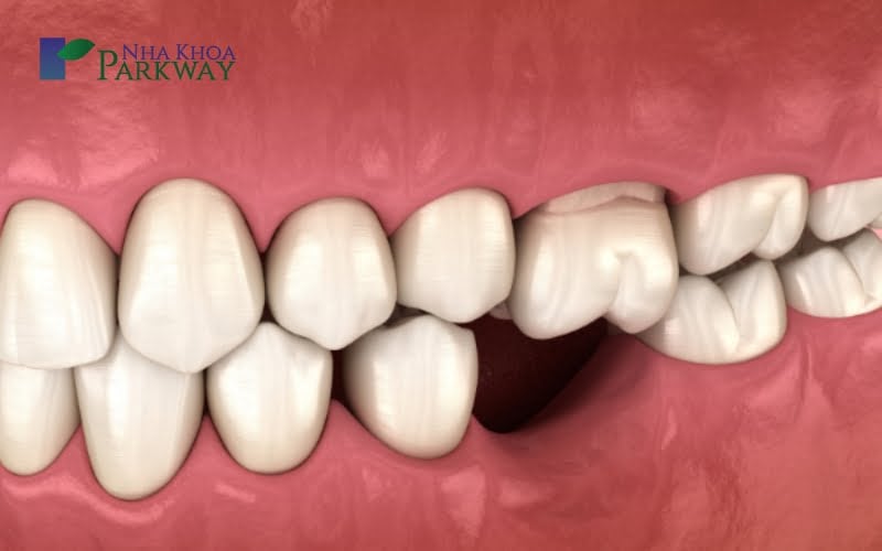 Hình ảnh bị mất 1 răng và bị tiêu xương ảnh hưởng tới những răng xung quanh
