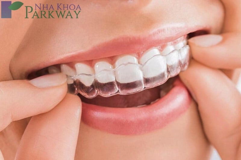 Những cách điều trị răng cửa bị vẩu triệt để nhất