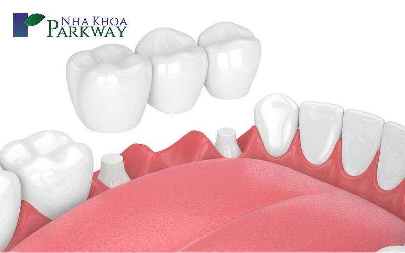 Hình ảnh cầu răng được lắp trên các răng trụ để lấp đầy khoảng trống nơi răng bị mất