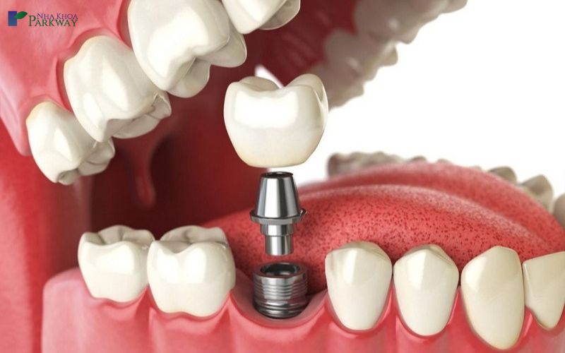 Hình ảnh trồng răng implant 