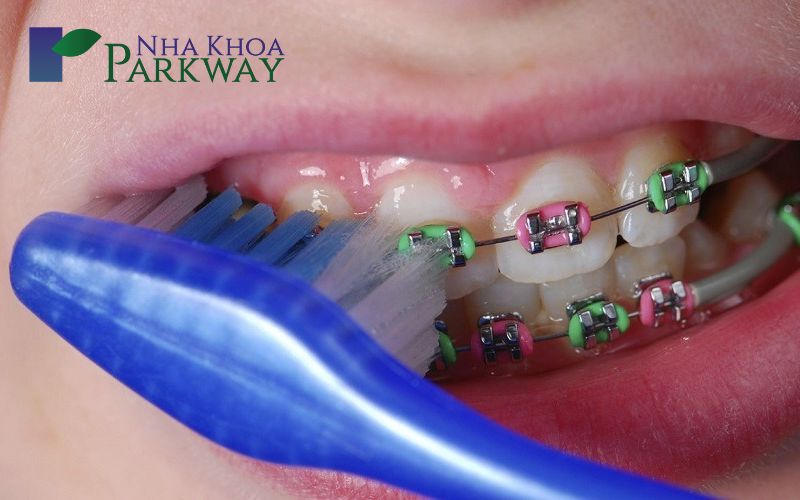 Quy trình niềng răng giả tại các nha khoa