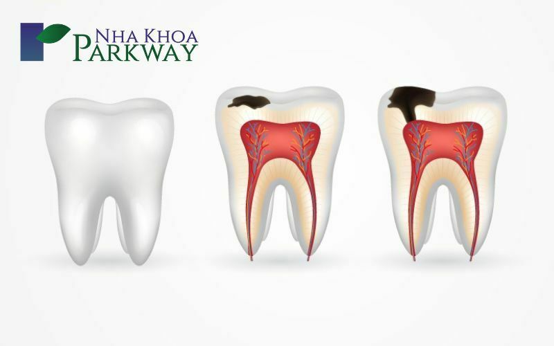 Hình ảnh 3 chiếc răng: khỏe, sâu nhẹ và sâu nặng