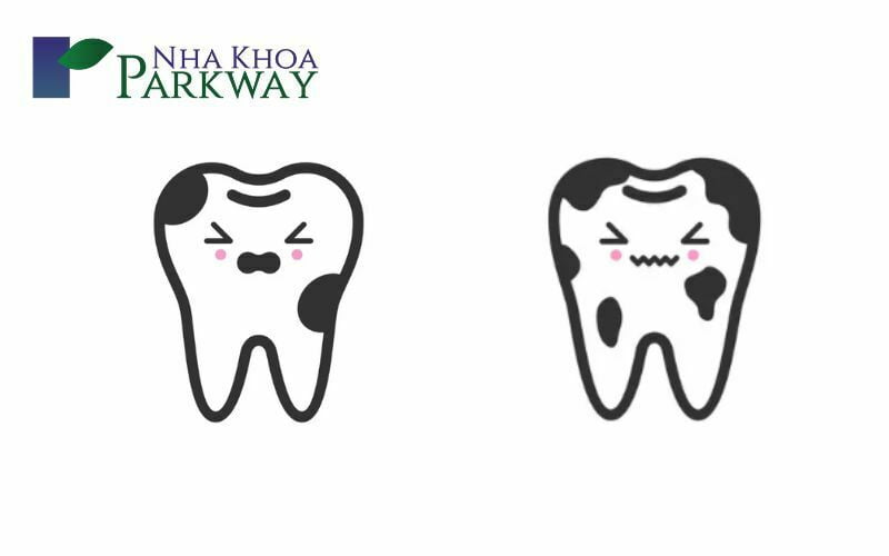 Sâu răng là một trong những nguyên nhân chính dẫn đến tình trạng vỡ răng hàm