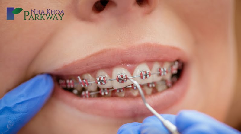 Phương pháp niềng răng hô nhẹ hiệu quả nhất