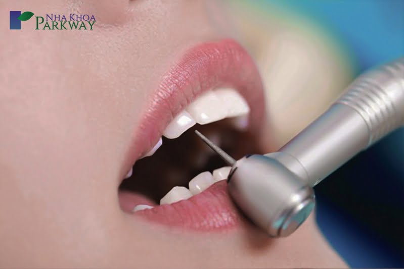 Các phương pháp điều trị răng hô nhẹ