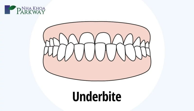 Hình ảnh mô phỏng hàm răng bị móm