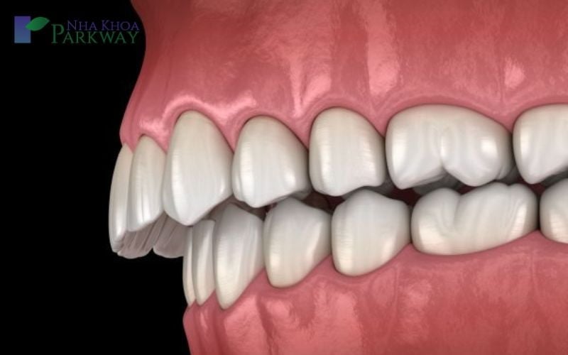 Có những loại răng vẩu hô nào?