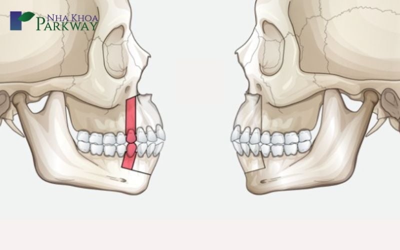 Cách phân biệt hô hàm hay hô răng chuẩn xác nhất