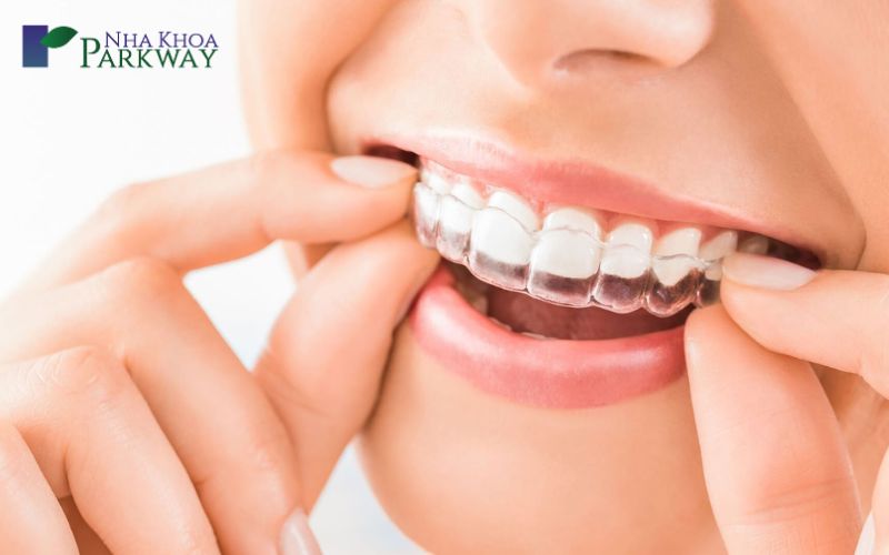 Các phương pháp điều trị răng hô hiệu quả 
